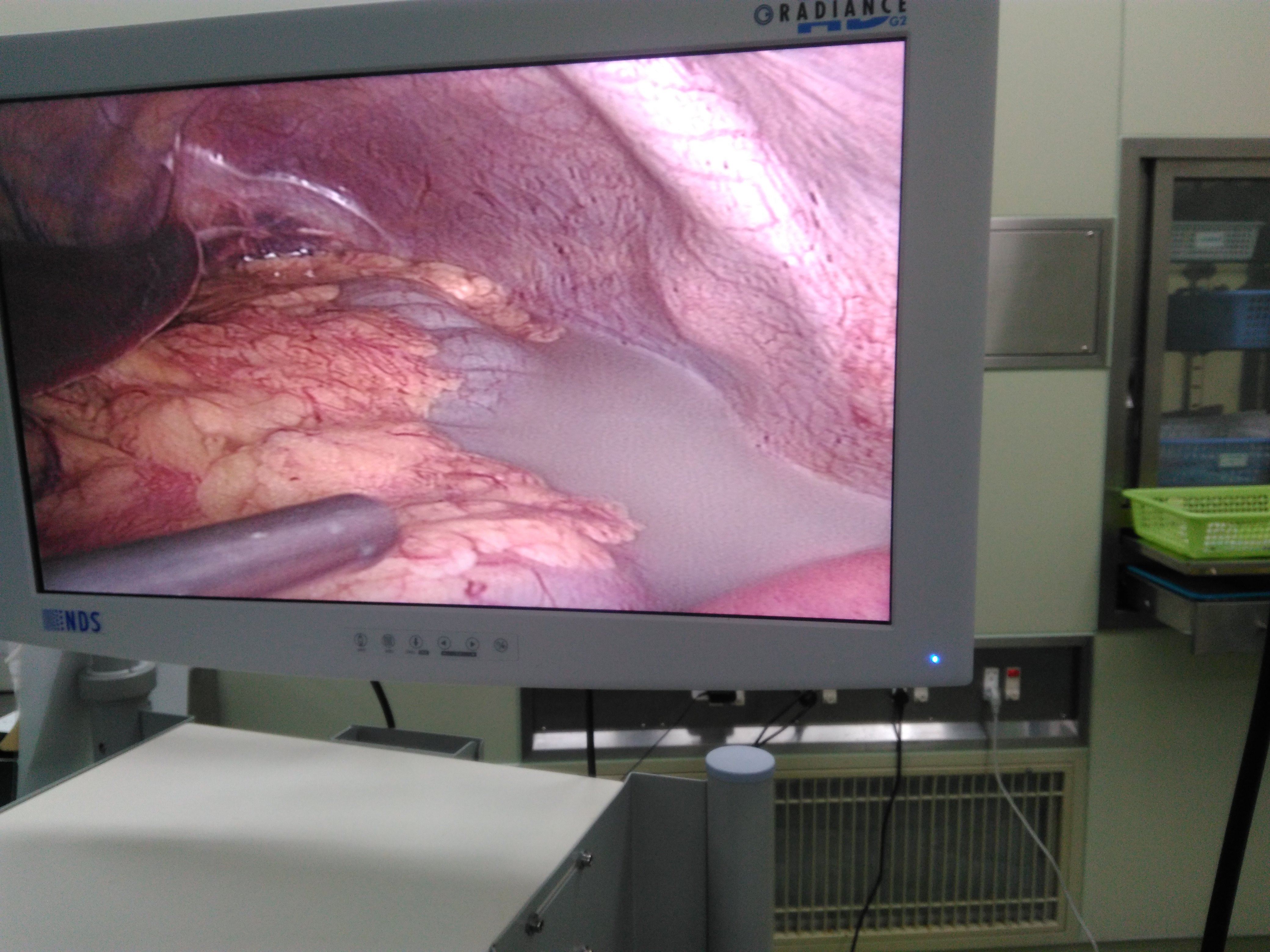 急性坏疽性阑尾炎穿孔伴弥漫性腹膜炎的微创治