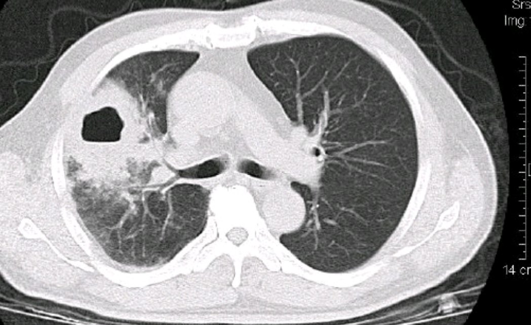 急性肺脓肿空洞
