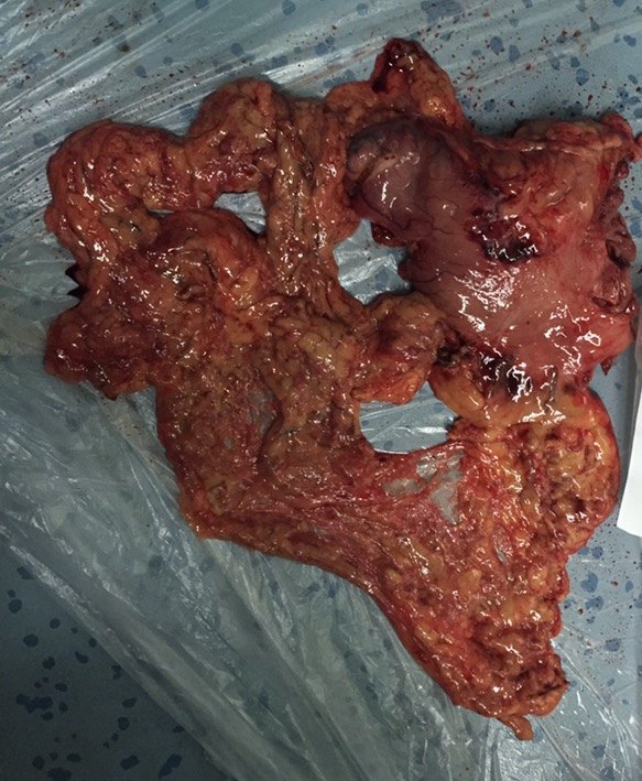 胃癌 直肠癌 同时双原发