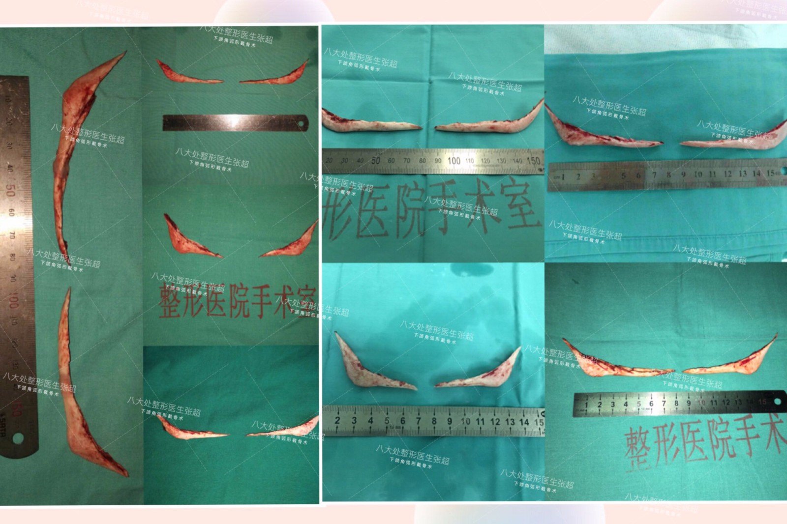 个性化下颌角弧形截骨术