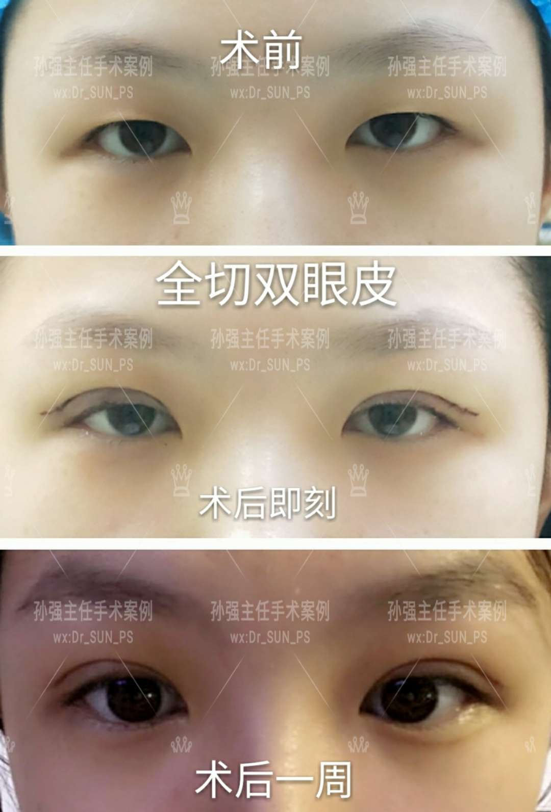 上海修复双眼皮的医生_双眼皮修复价格_全切双眼失败修复图