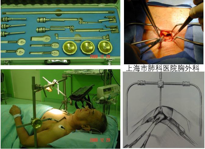 经剑突下胸腔镜手术