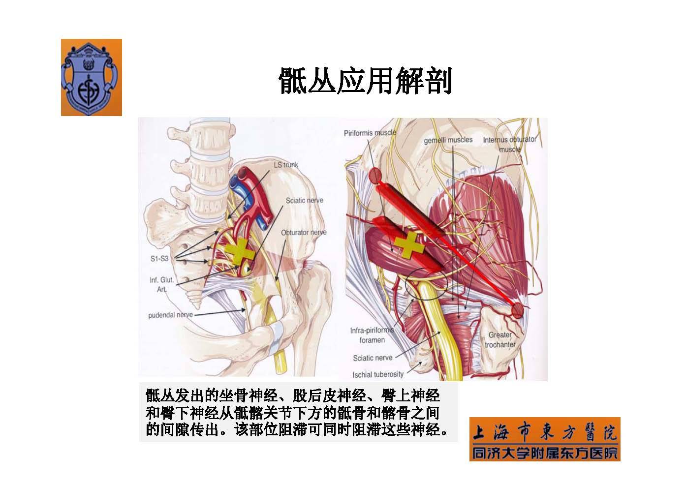 > 实用骶丛神经阻滞