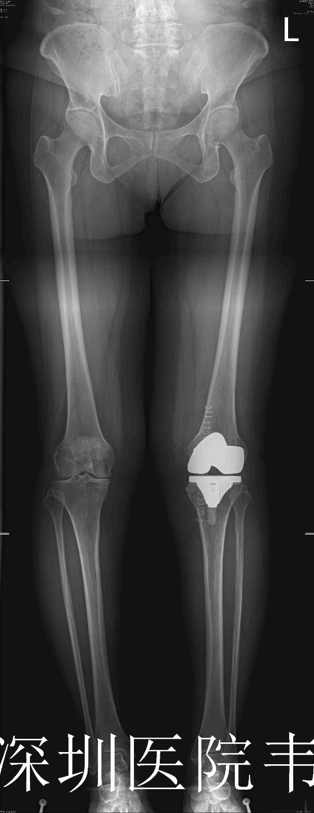 膝关节表面置换术x片示例