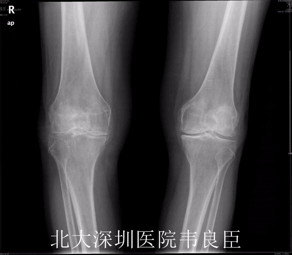 膝关节表面置换术x片示例