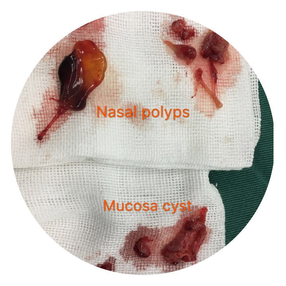 鼻息肉如何治疗