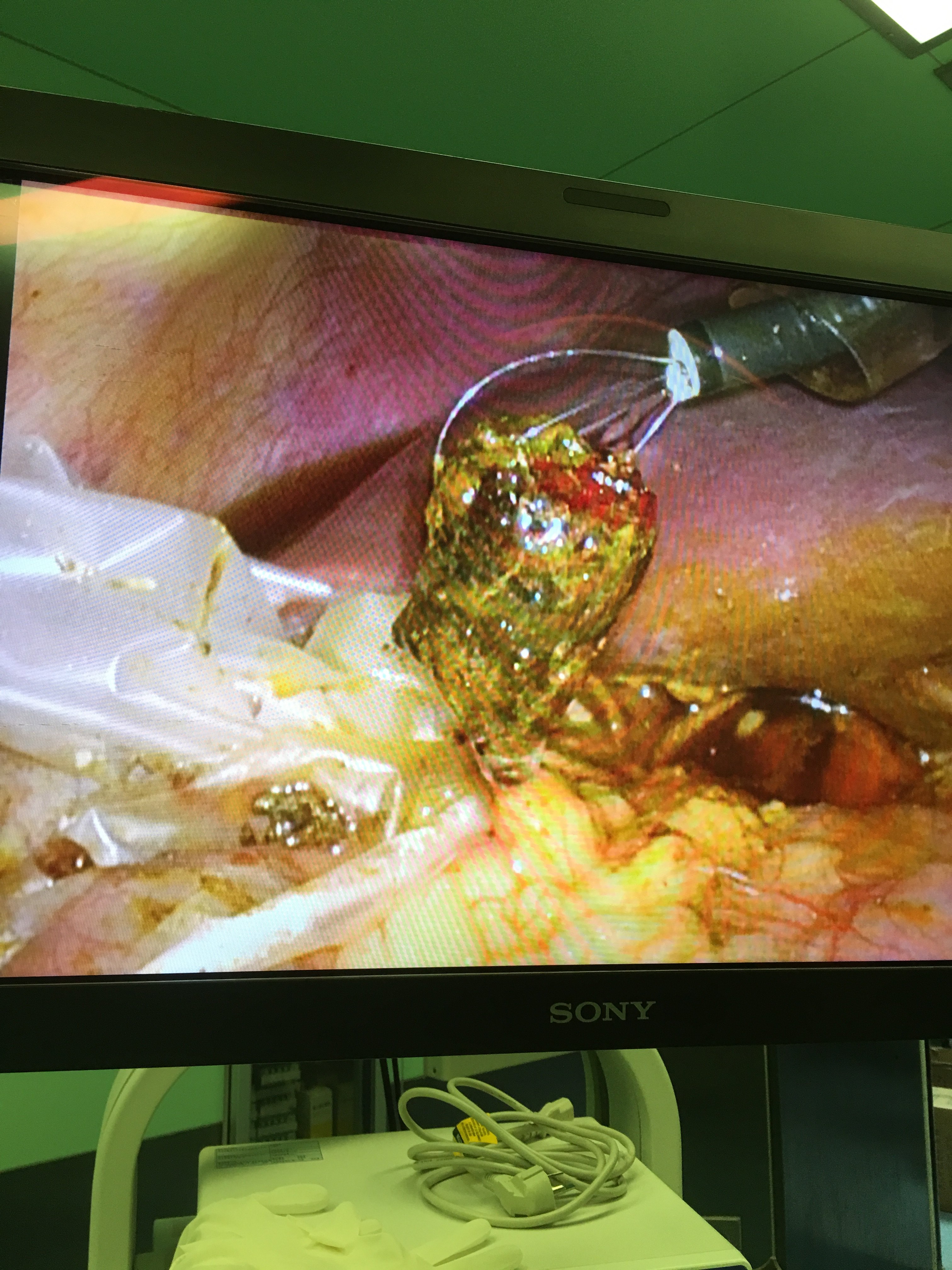 原创 三孔法3d腹腔镜胆囊切除,胆总管探查