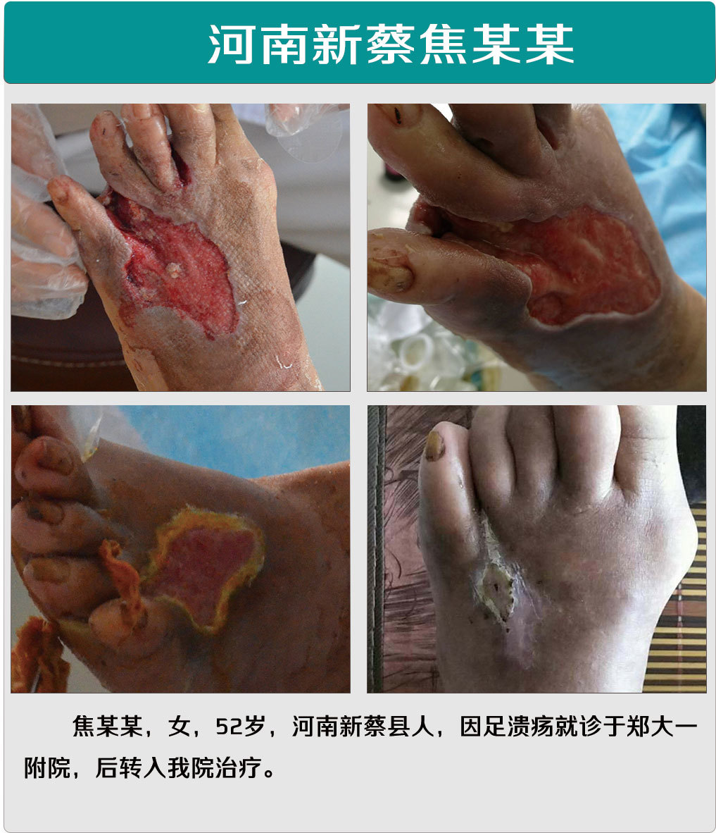 糖尿病足怎么治疗?