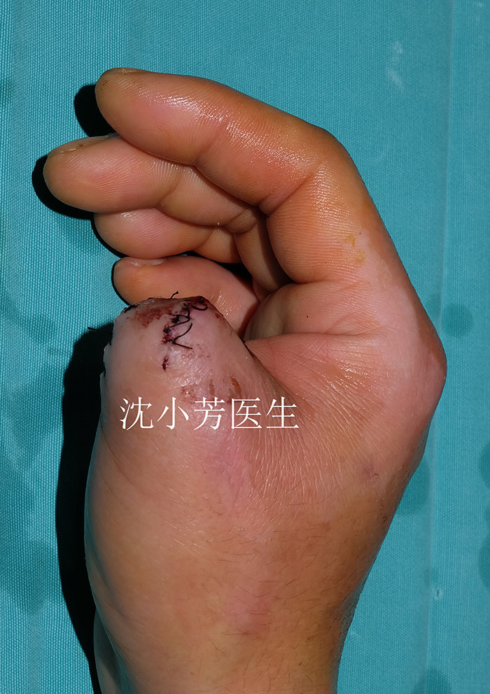 拇手指坏死缺损的再造