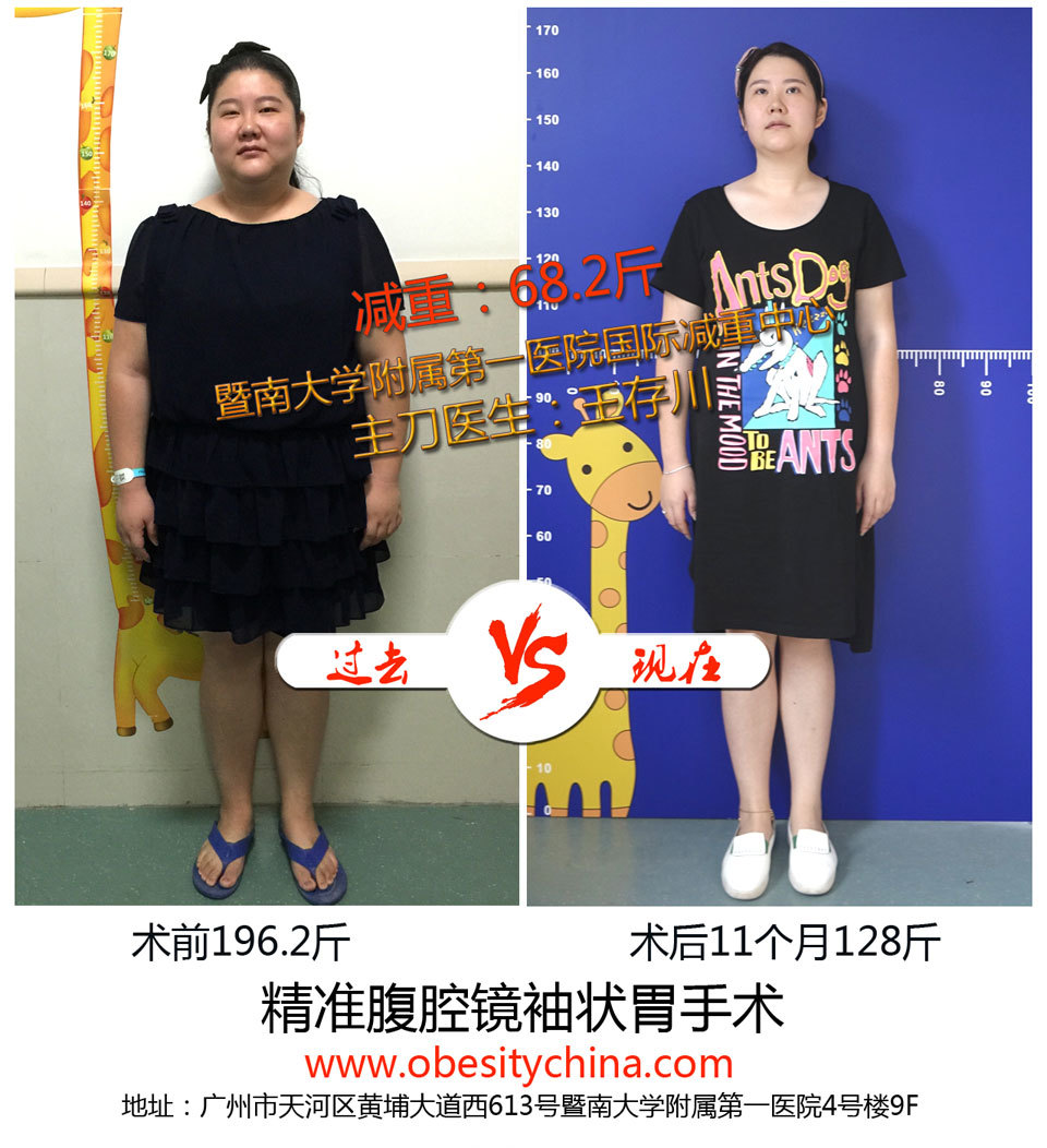 湖北杨胖妞减重后的自诉:减肥手术让我怀孕生子不肥胖(下)