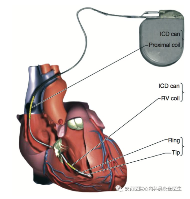 如何预防心源性猝死——植入式心律转复除颤仪_心脏