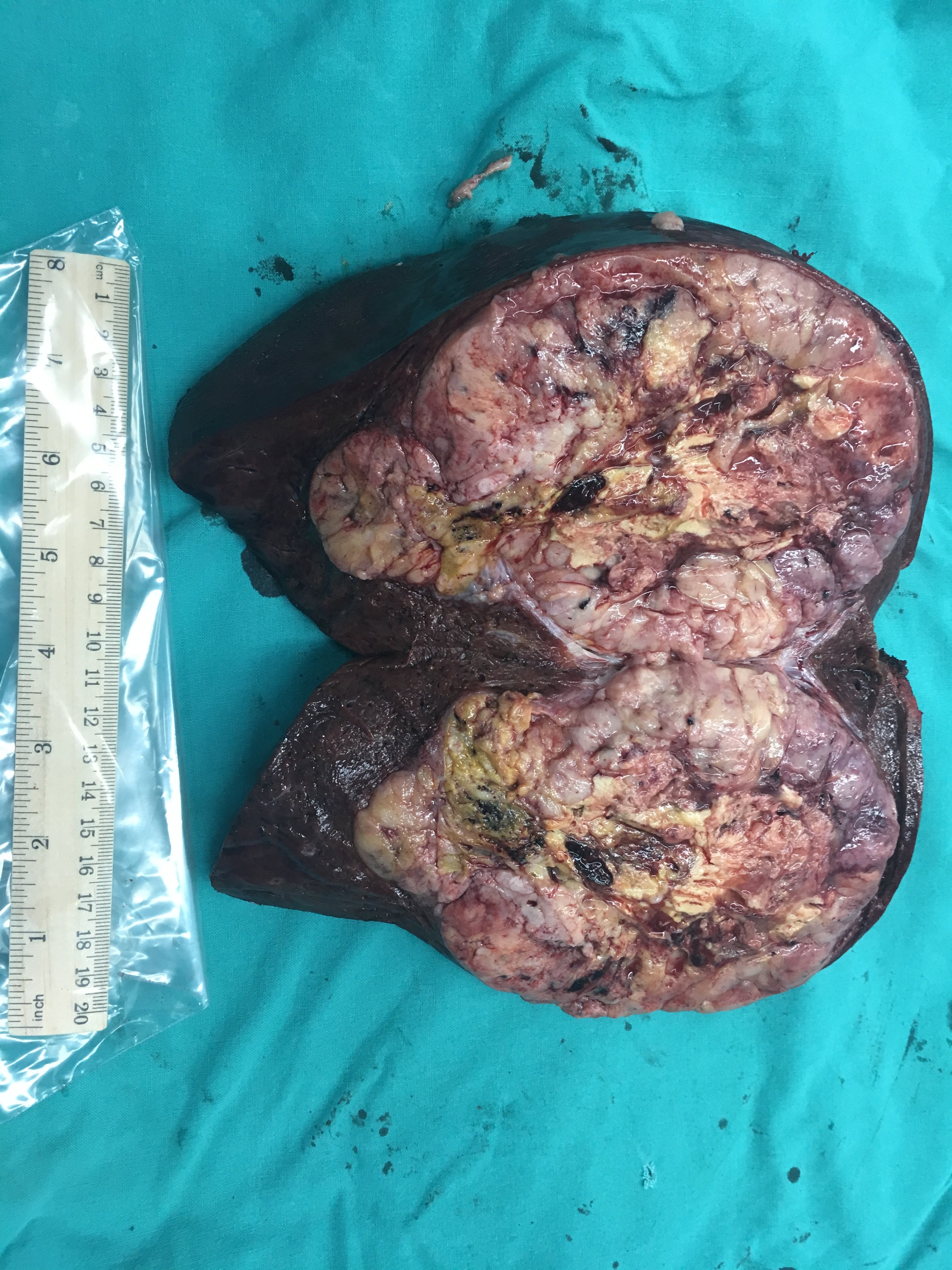 肝右叶巨大肝肿瘤(肝癌)行右半肝切除术