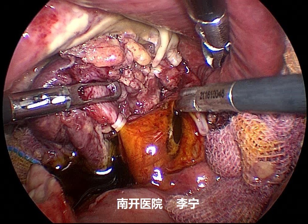 点(入院24小时)施行了腹腔镜下胆囊切除 胆总管探查取石 胆管内支架植