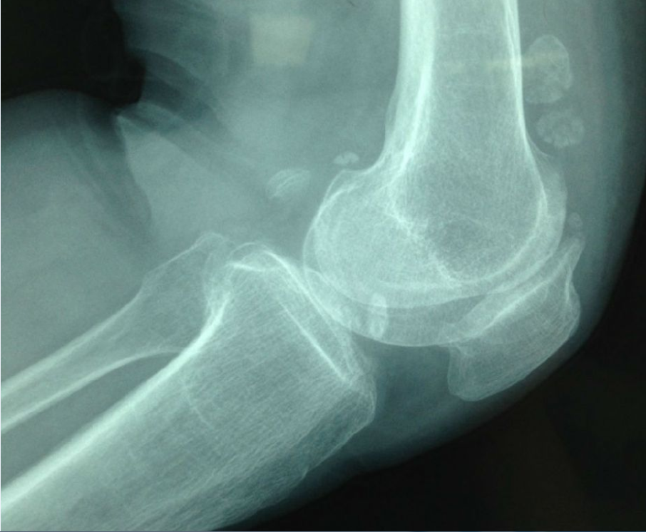 走着走着膝盖突然被卡住--膝关节游离体知多少