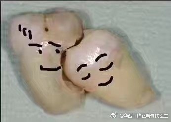 常见正牙问题7:医生建议拔智齿,但还没长起来