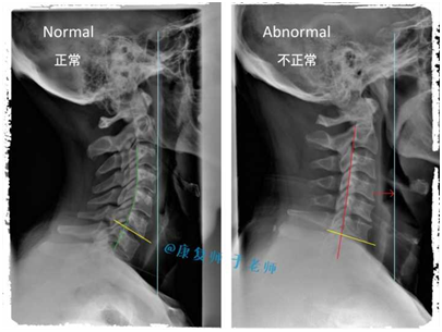 颈椎生理曲度变直怎么办?
