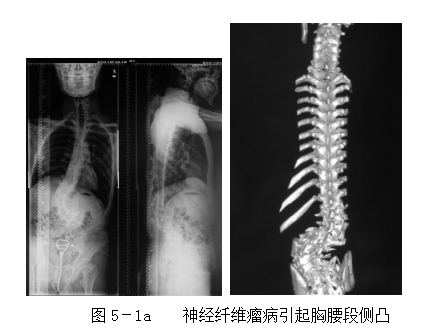 好大夫在线 于淼 脊柱侧弯的分类神经纤维瘤病i型也非常容易引起