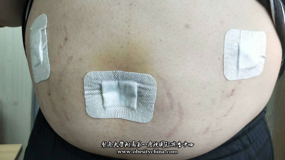 腹腔镜手术治疗肥胖和糖尿病的优势