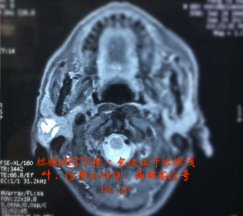 腮腺肿瘤诊治体会