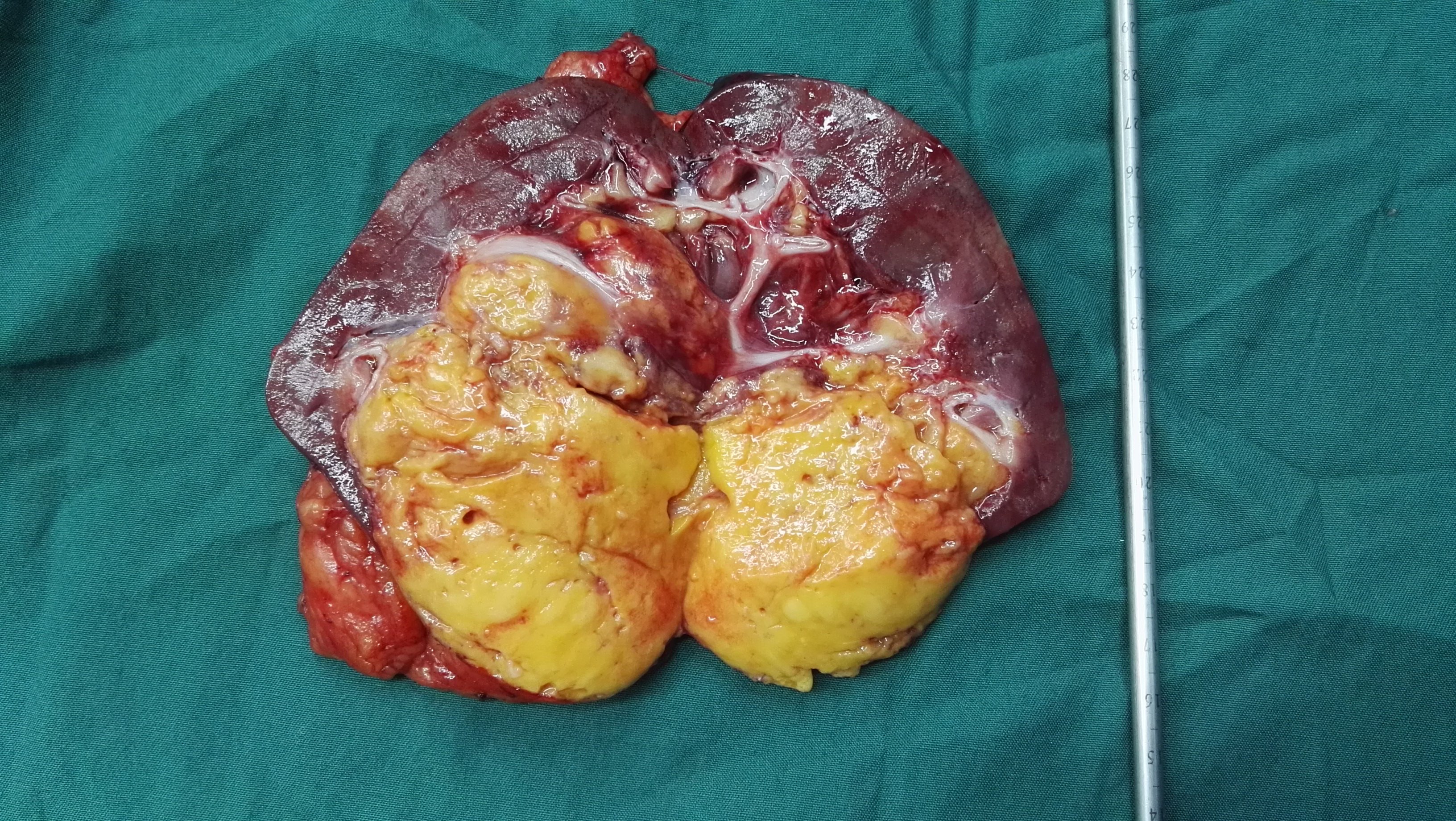 巨大的肾错构瘤,哪些可以微创手术保留肾脏?
