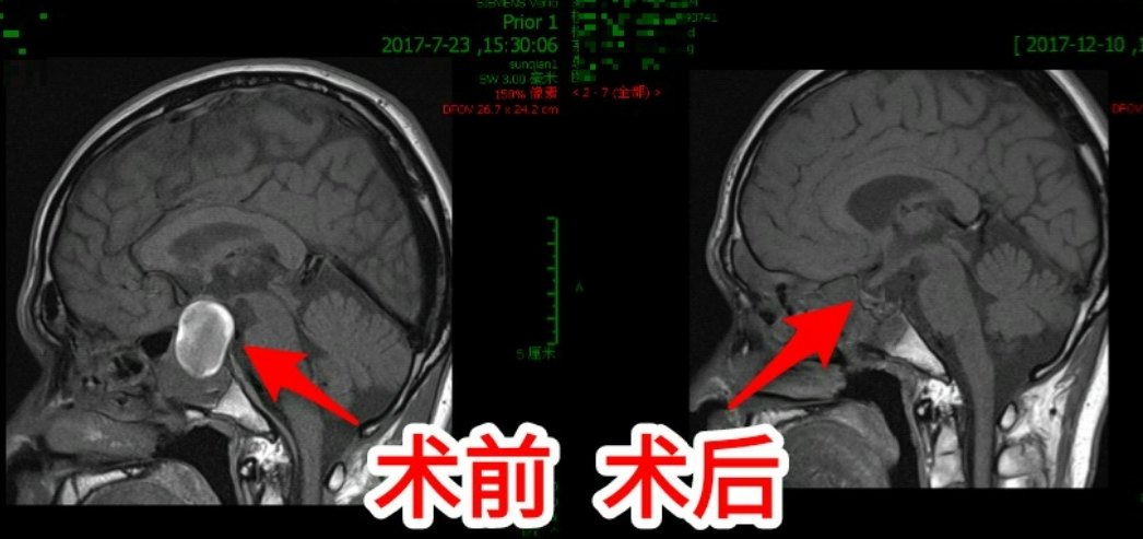 神奇的神经内镜微创手术治疗垂体瘤