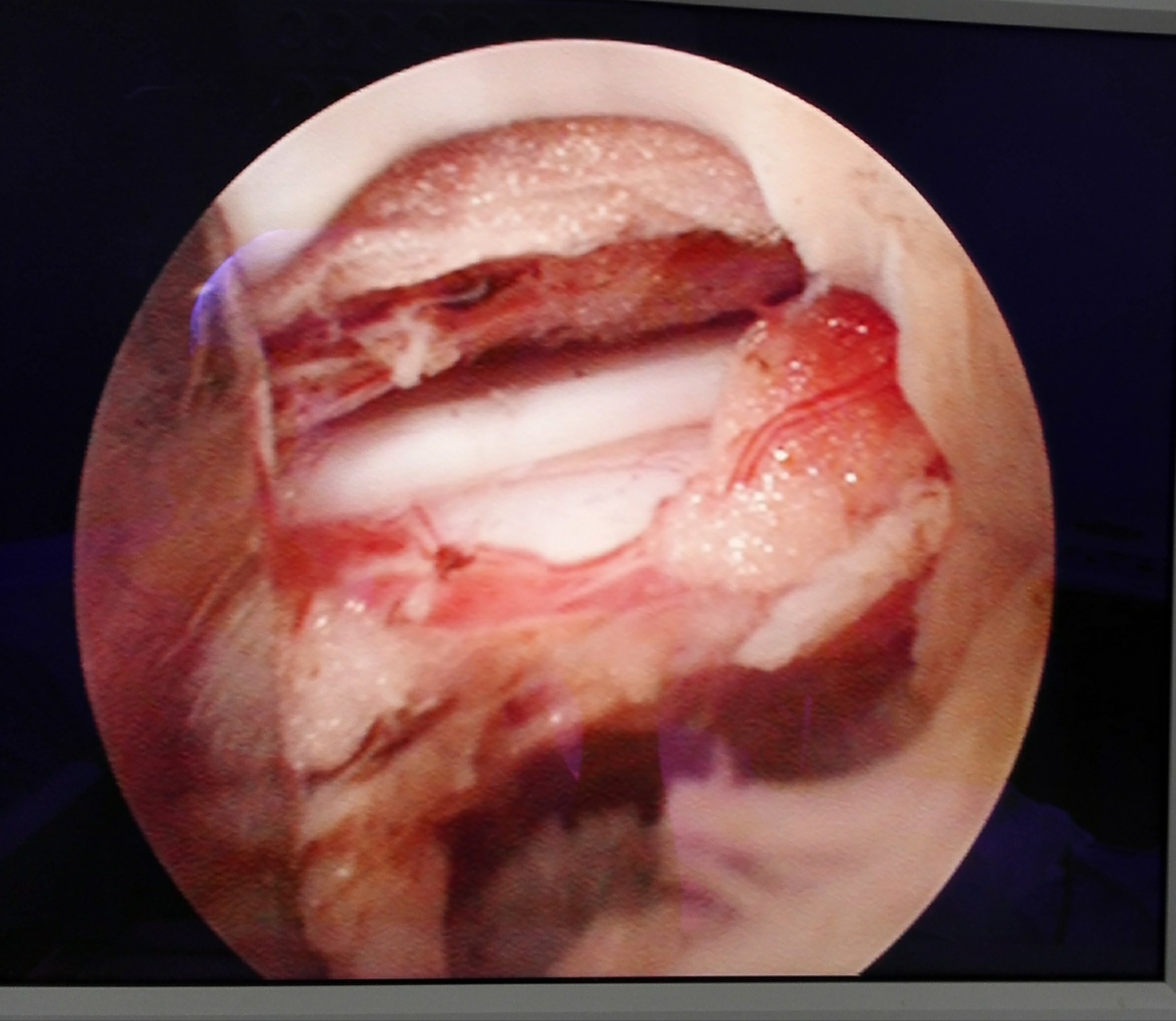 腰椎间盘突出症,微创椎间孔镜间盘摘除术!
