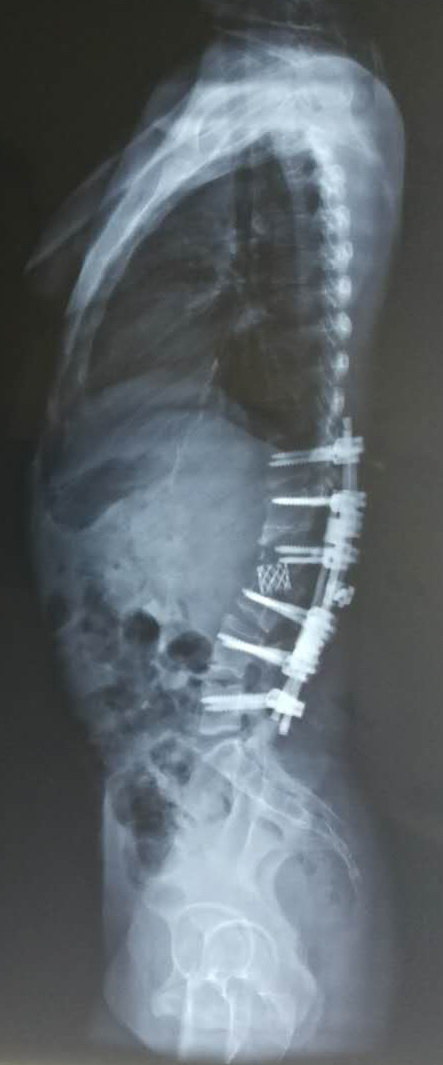 重度脊柱后凸畸形的截骨矫形