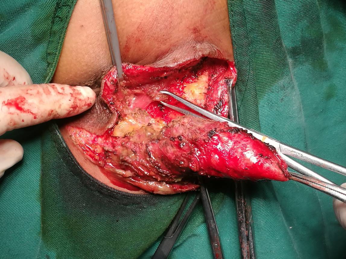 肛周巨大表皮样囊肿一例