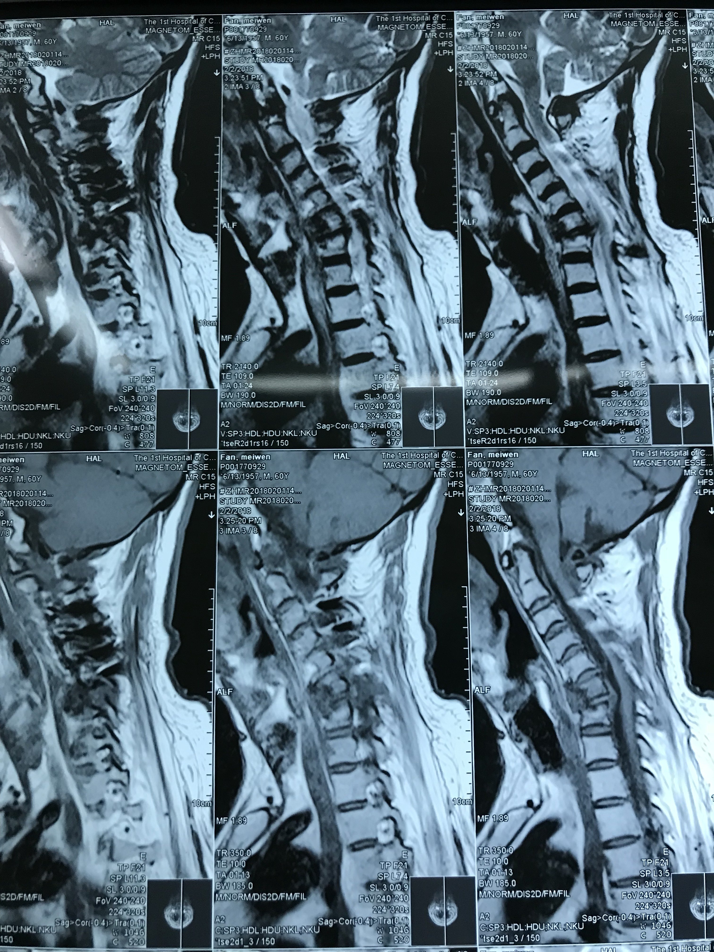 张令 文章列表  术前颈椎正位片 术前颈椎mri 术前ct三维重建 术中c臂