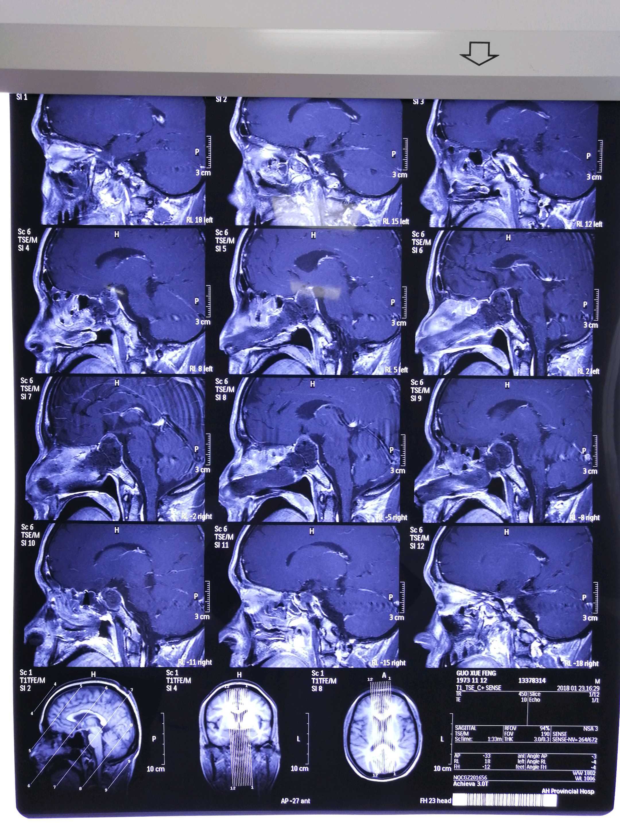 侵袭性垂体巨大腺瘤在垂体瘤的诊治中一直以来都是一个难点,无论采用