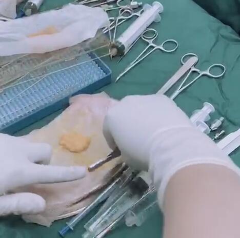 【面部填充】自体脂肪填充法令纹和眉弓骨 -- 