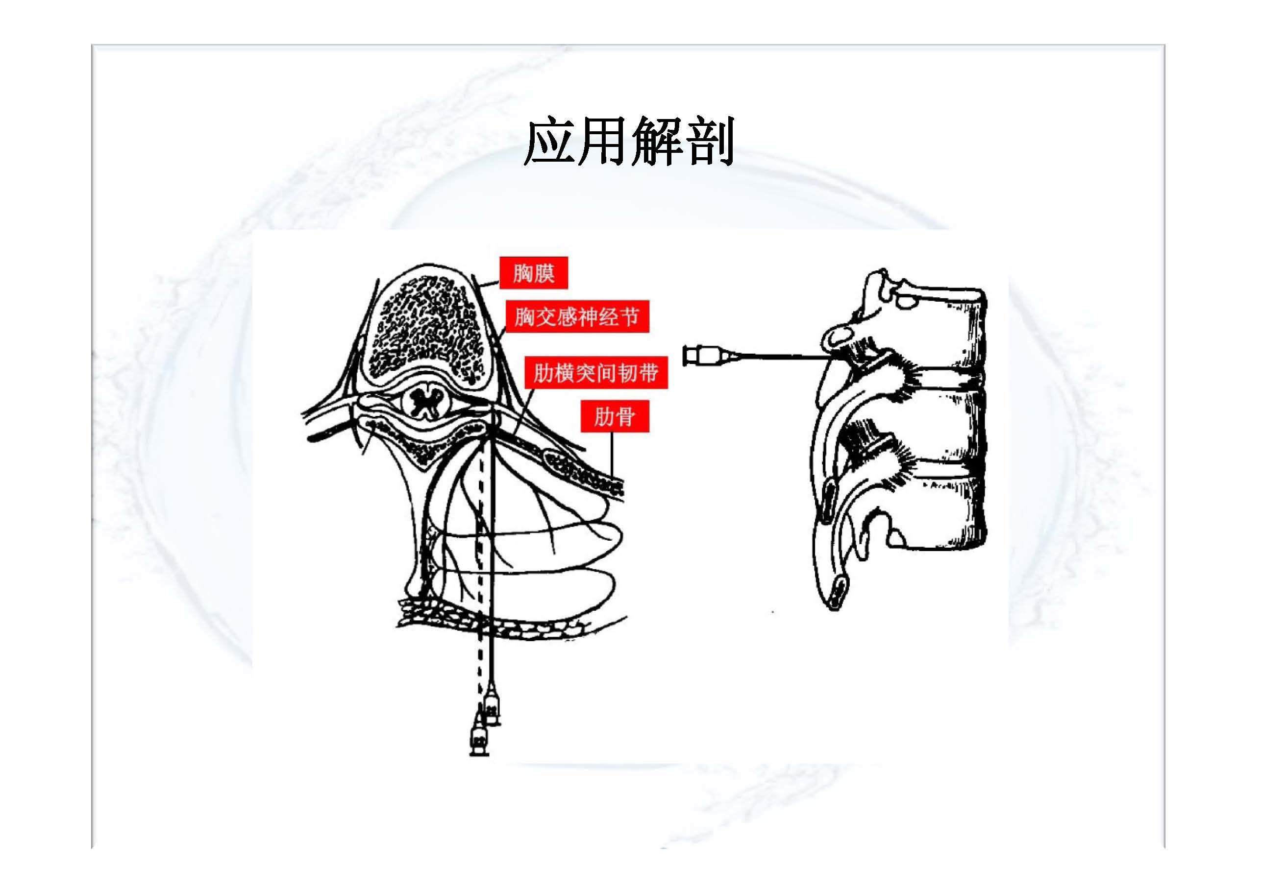 实用胸椎椎旁神经阻滞