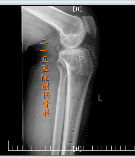 胫骨平台骨折术后骨性愈合