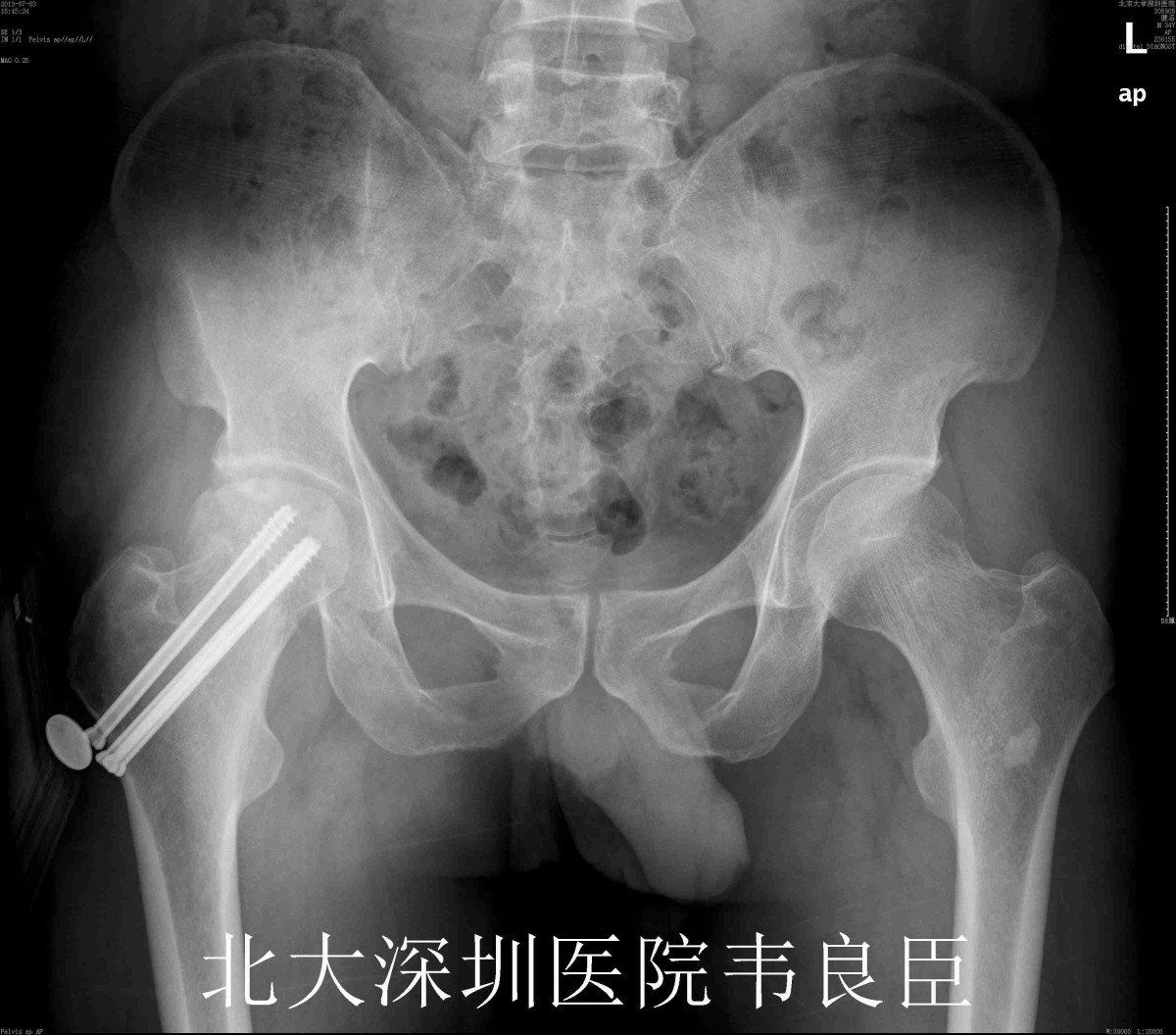 股骨颈骨折髋臼骨折术后股骨头坏死行髋关节置换病例x片