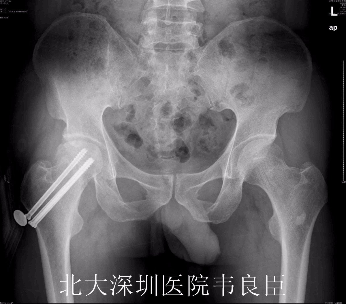 股骨颈骨折,髋臼骨折术后股骨头坏死行髋关节置换病例