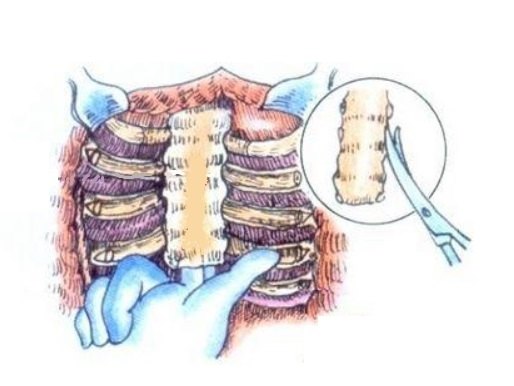 今天的鸡胸超微创手术:无管、无胸腔镜、微切