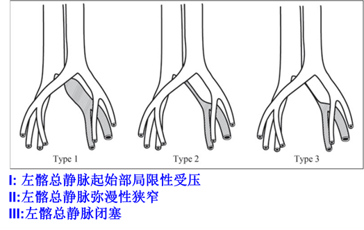 微创治疗—下肢深静脉血栓