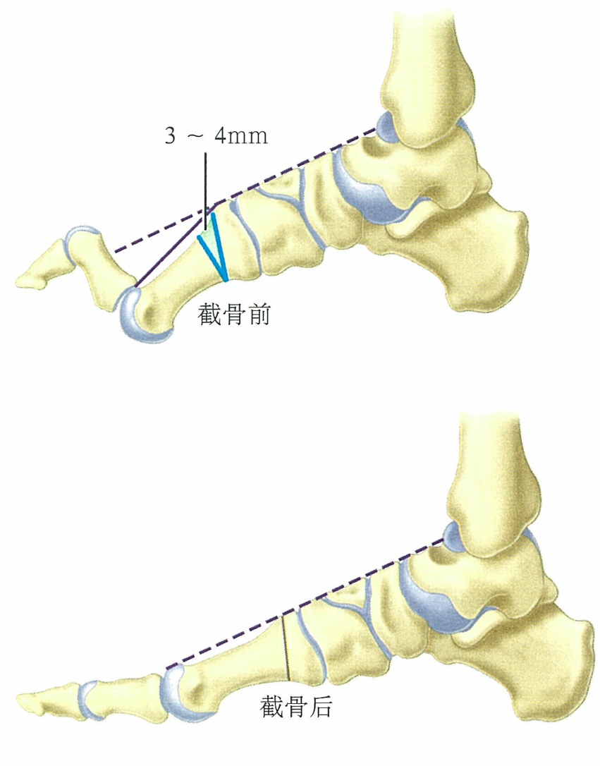 高弓足畸形诊治与病例分享