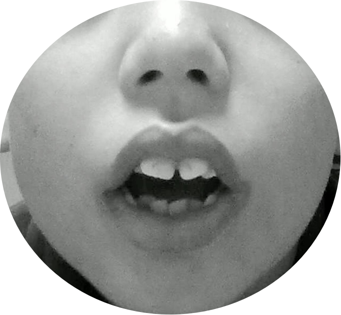 腺样体面容:牙列不齐,上切牙突出,唇厚,缺乏表情的面容,也可以成为"