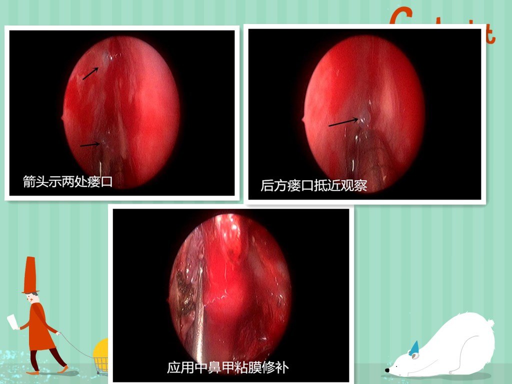 脑脊液鼻漏