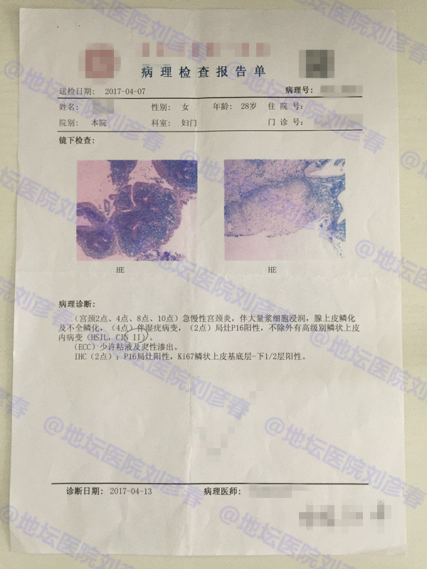 病例分享——宫颈湿疣是什么?会导致宫颈病变吗?