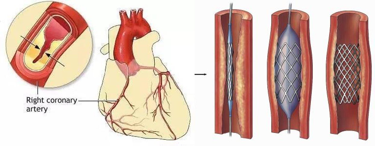 冠状动脉造影和支架手术的前世今生
