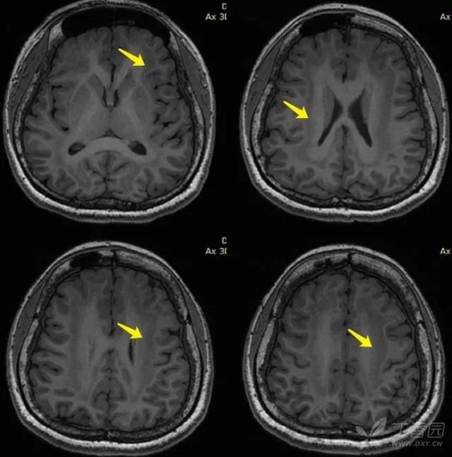 灰质异位导致的癫痫