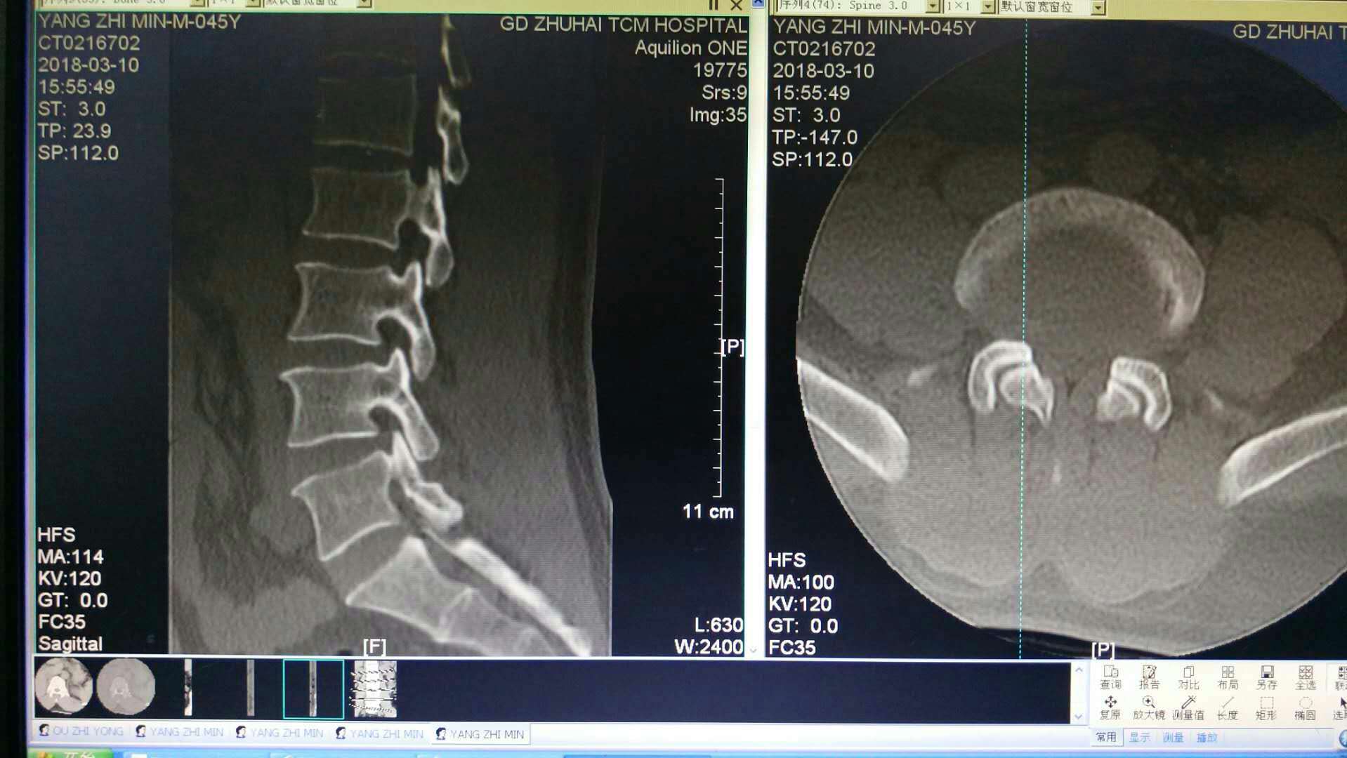 椎间孔镜治疗腰椎管狭窄典型病例