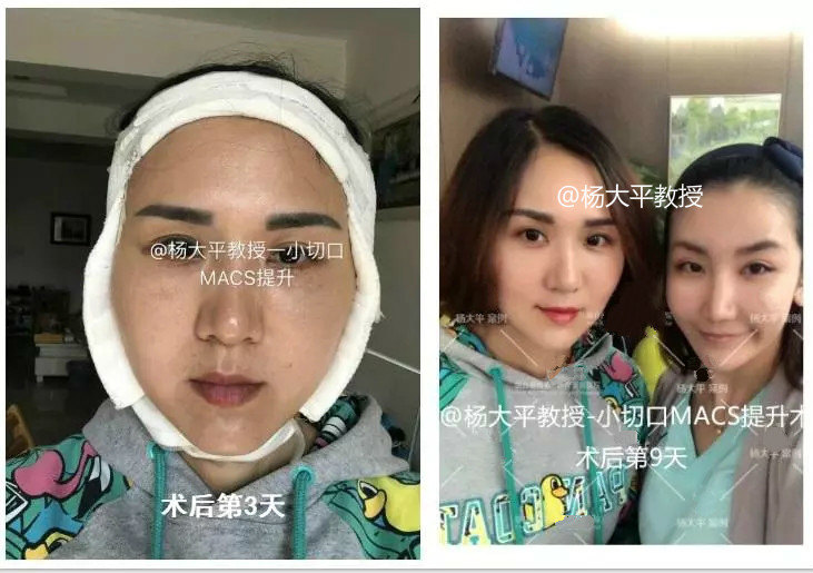 面部提升手术对鼻唇沟的改善作用