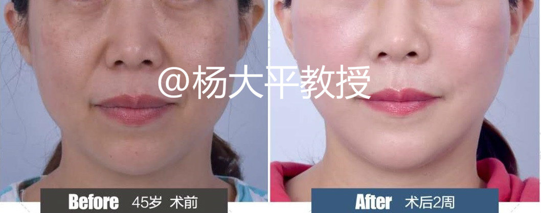 面部提升手术对鼻唇沟的改善作用