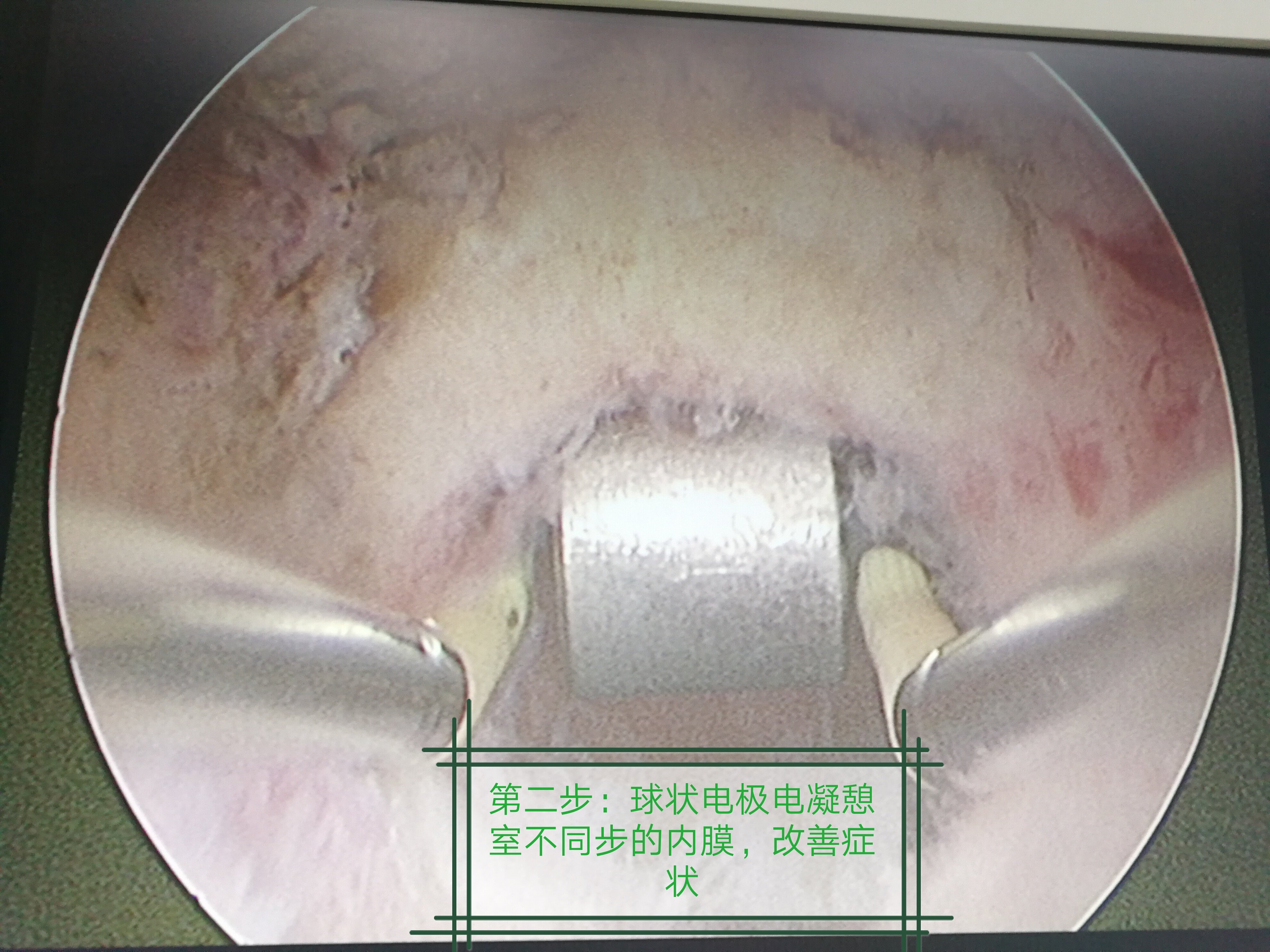 手术解析:宫腔镜下切除-剖宫产术后子宫切口憩