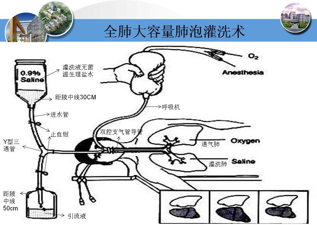 大容量全肺灌洗术是向肺内灌入无菌生理盐水,通过水的冲洗,把