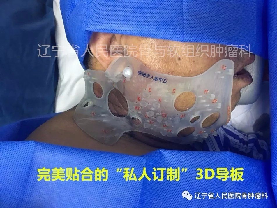 3D模版引导粒子植入治疗肺癌颈部多发淋巴结转移