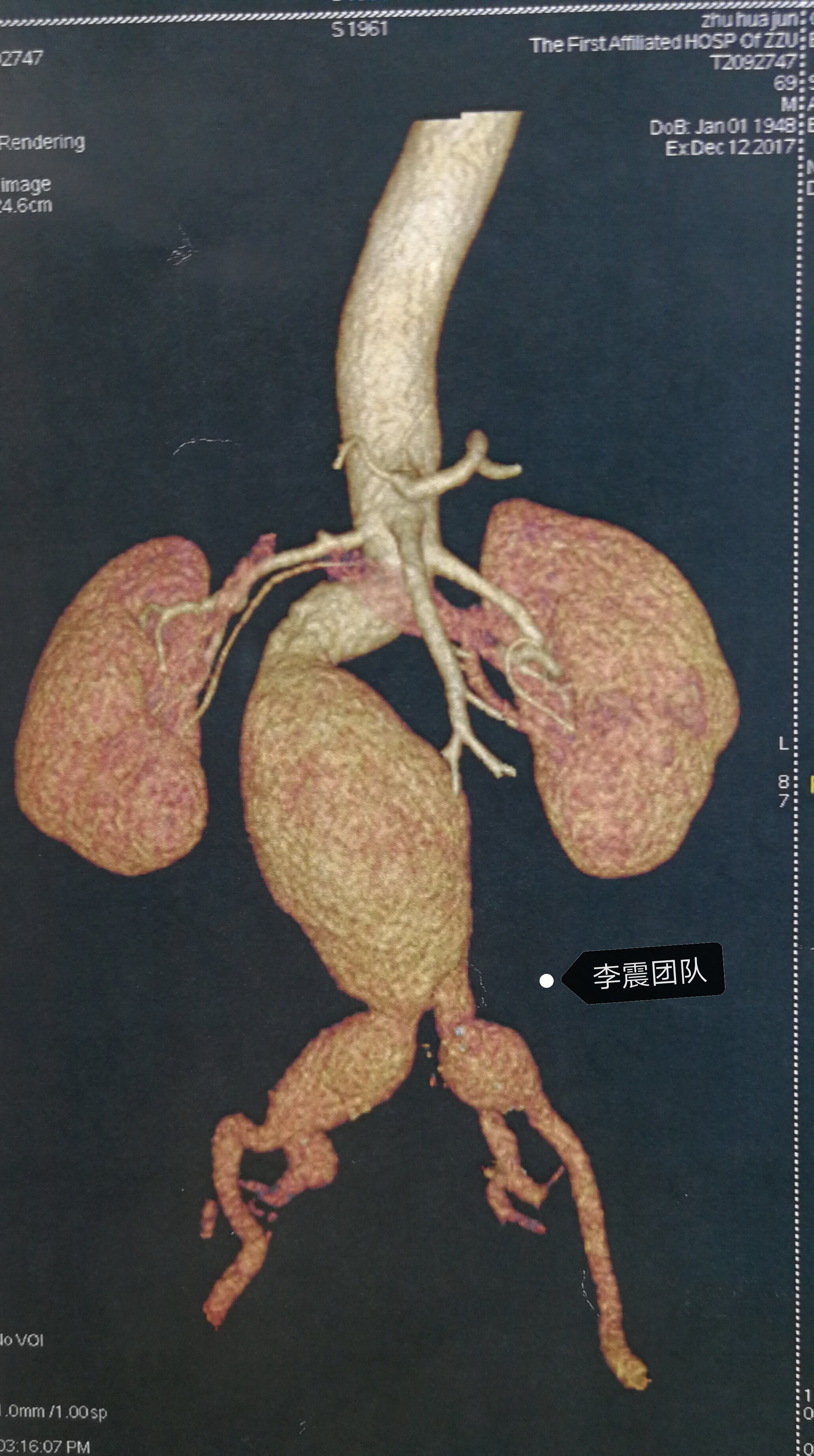 腹主动脉瘤手术方式您说了算